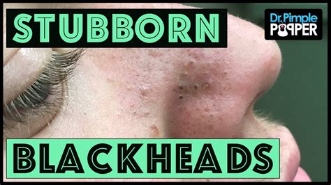 dr pimple blackheads